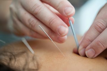 Photo of acupuncture treatment and acupuncturist inserting acupuncture needles