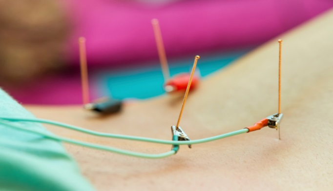 Picture of electroacupuncture